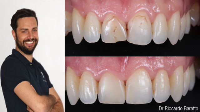 Achieving perfect symmetry: restoring central incisors